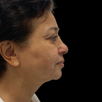 before-deep-plane-facelift-necklift-chin-implant